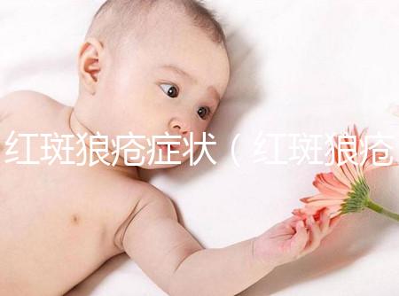 紅斑狼瘡癥狀(紅斑狼瘡癥狀表現有哪些)