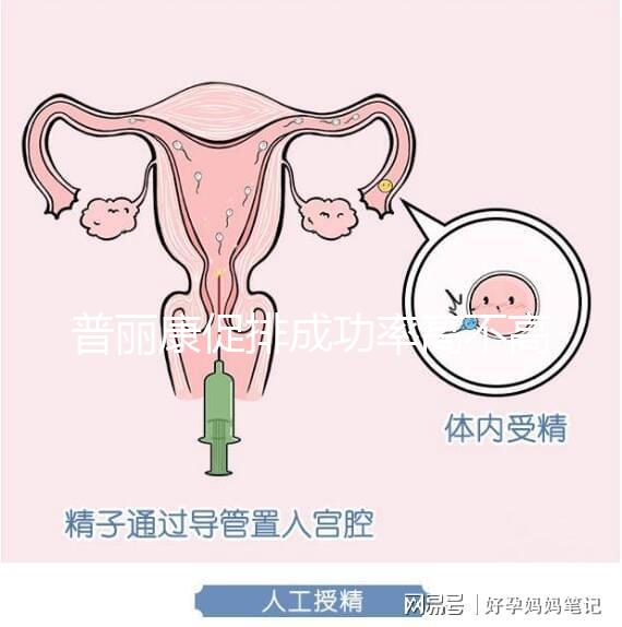 普麗康促排成功率高不高揭秘，能否取出卵泡的關鍵看…