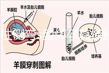 脊柱側彎s型懷孕莫慌張，能否順產還得看這4大要素